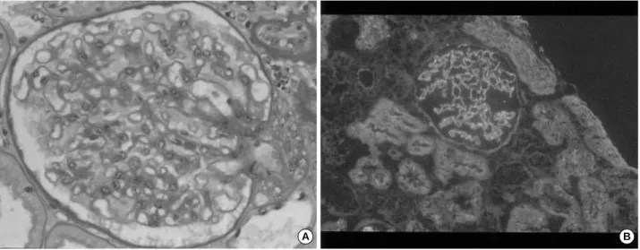Fig. 1. Membranous glomerulonephropathy. (A) Light micrograph (×200, PAS stain) reveals minimal glomerular changes with focal tubular atrophy, mild interstitial fibrosis and mild diffuse thickening of glomerular basement membrane without evidence of Inflam