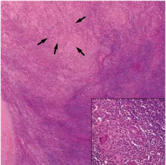 Fig. 1. Lymph node biopsy (H&amp;E stain, ×20). Microscopically, the mass exhibits diffuse effacement of lymph node architecture and granulomas