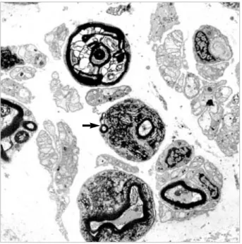 Fig. 3. Sural nerve biopsy (modified Gomori trichrome stain, ×100).