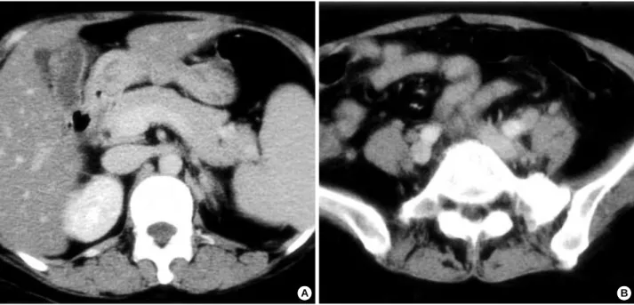 Fig. 1. Computed tomographic findings of abdomen appear acute acalculous cholecystitis and ileocolitis