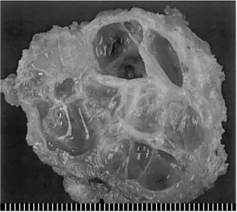 Fig. 1. The cut surface of the mass shows numerous cysts, mea- mea-suring up to 1.2 cm in diameter, with a gelatinous secretion.