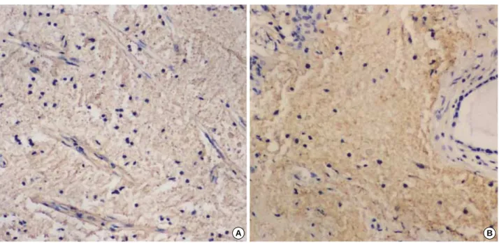Fig. 4. Immunohistochemical features. The lesion shows diffuse positive reaction for GFAP (A) and S100 protein (B) (×100).
