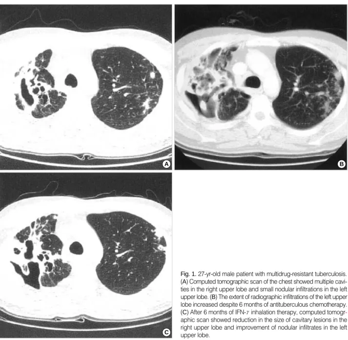 Fig. 1. 27-yr-old male patient with multidrug-resistant tuberculosis.