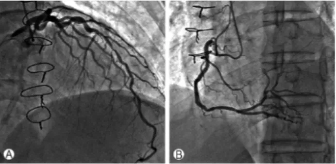 Fig. 5. Follow up coronary angiogram. (A) Right coronary angio- angio-gram. (B) Left coronary angioangio-gram.