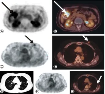 Fig. 2. The fluorodeoxyglucose positron emission tomography (FDG-PET) scan showed an hypermetabolic lesion in the right  ascending colon (A, B) and a left breast nodule (C, D), but there  was no abnormal FDG uptake in the small pulmonary nodules (E-G).