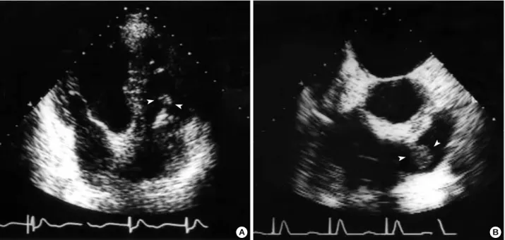 Fig. 1. (A) Transthoracic echocardiogram, apical four-chamber view. A pacemaker lead with attached hyperechoic materials is seen in the right ventricle