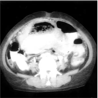 Fig. 2. Small bowel series shows submucosal tumor at distal ileum, suggesting a lymphoma with aneurysmal dilatations or  gastroin-testinal stromal tumor.