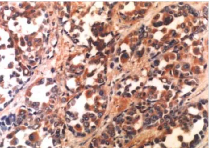 Fig. 5. Result of immunohistochemical staining with HMB-45 is positive (×200).