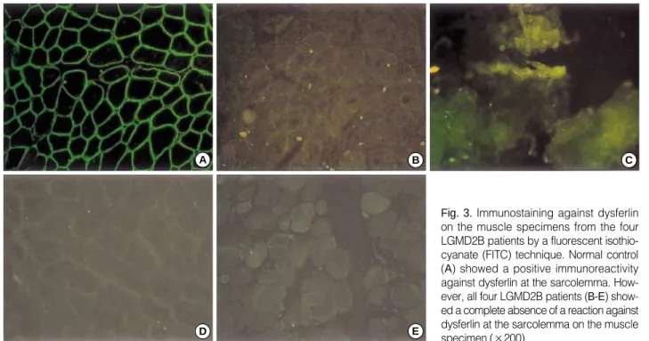 Fig. 3. Immunostaining against dysferlin on the muscle specimens from the four LGMD2B patients by a fluorescent  isothio-cyanate (FITC) technique