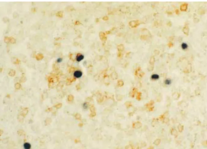 Fig. 4. CD3-positive T lymphocytes were harboring EBV genome in their nuclei (Double procedure for CD3 immunohistochemistry and EBER in situ hybridization ×400).