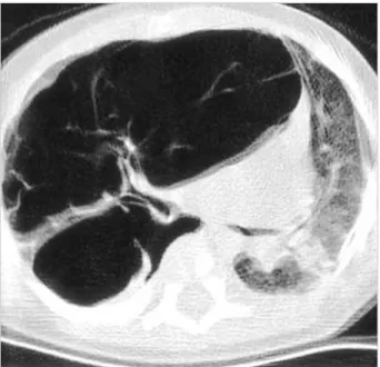Fig. 2. 1:1 scaned photograph shows a large intrapulmonary cys- cys-tic tumor (Ly), causing emphysematous change (Em) in  surround-ing pulmonary parenchyma (H&amp;E, ×1).