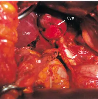 Fig. 1. Sonographic finding showing a well-defined round cystic mass adjacent to the gallbladder, the lesion is filled with echogenic materials