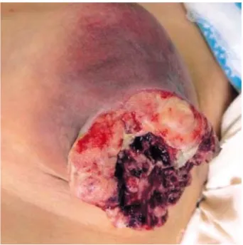 Fig. 1. Gross finding of the tumor. The tumor involves almost the entire left breast, which is rotted by extensive necrosis and  inflam-mation.