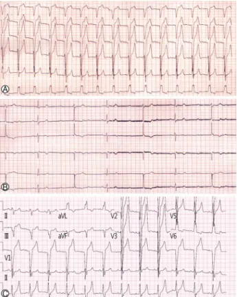 Fig. 2. Electrocardiogram showing pre-existing left bundle branch block (A). Development of complete atrioventricular block during guide-wire insertion (B)
