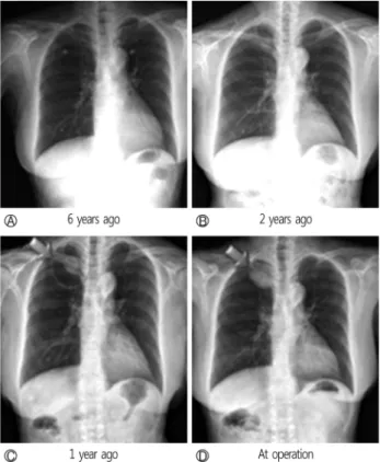 Fig. 2. (A) Contrast chest computed tomography scan shows a  non-enhancing 25 mm well-defined low density nodule at the  right upper anterior mediastinum