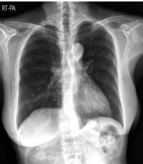 Fig. 5. Chest X-ray, taken 1 year after the operation, shows no abnormal finding without signs of recurrence.