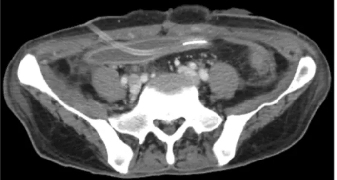Fig. 4. Abdominal computed tomography scan finding on post  operation day 7. Ileostomy and drainage tube insertion in the peritoneal cavity