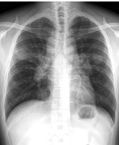 Fig. 2. Contrast enhanced chest computed tomography scan showed bihilar lymphadenopathy and bilateral pulmonary infiltration.
