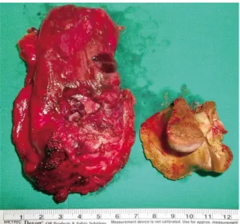 Fig. 2. Abdominal computed tomographic image showing a foreign body (a sharp pig backbone) lodged in the rectum with rectal  perforation and peritonitis.