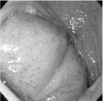 Fig. 2. Computerized tomographic finding. A cystic lesion with a distinct wall in the second-to-third portion of the duodenum (A, B) is shown.