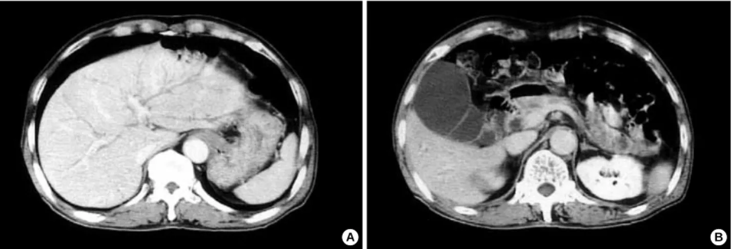 Fig. 3. Computerized tomographic finding. Dilated intrahepatic duct (A) and a common bile duct and markedly distended the gallbladder (B) is shown.