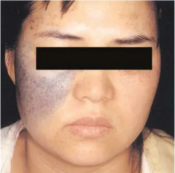 Fig. 2. Mottled brownish macules on both forehead and both lower eyelids (ABNOM lesion).