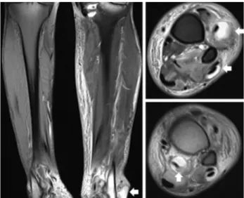 Fig. 2. Fat-saturated proton-density-weighted magnetic resonance imaging showing soft tissue edema at the left lower extremity  and a cystic lesion on the superficial portion of the lateral  malleo-lus