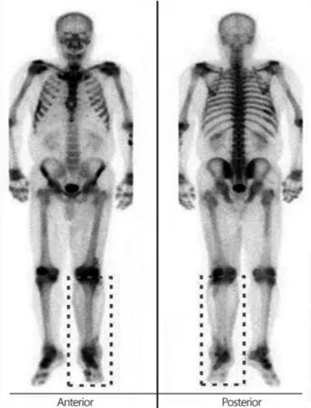 Fig. 3. Whole body bone scan showing hot uptake at the left lower leg reminiscent of cellulitis.