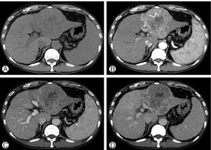 Fig. 1. Liver dynamic computed tomography images before treat- treat-ment with sorafenib showing a 7.5-cm hypervascular mass with  delayed washout in the left lobe