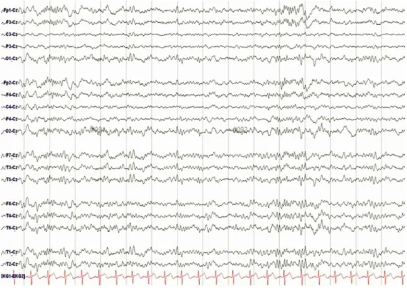 Fig. 2. Electroencephalography (EEG) finding. There are bilateral slowing posterior background rhythms,  indicating mild cerebral dysfunction