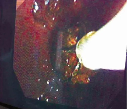 Fig. 4. Stone removed using a basket after endoscopic sphinctero-  tomy.