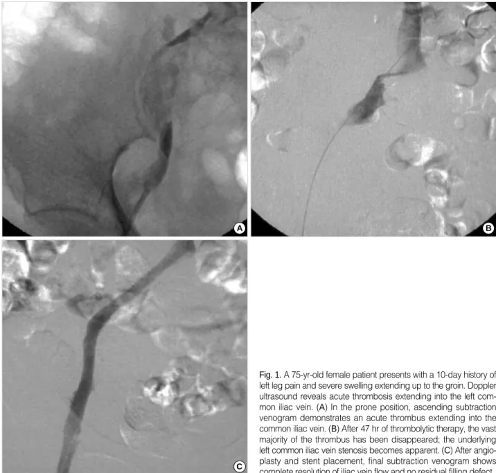 Fig. 1. A 75-yr-old female patient presents with a 10-day history of left leg pain and severe swelling extending up to the groin