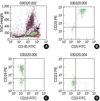 Fig. 2. Immunophenotyping of malignant lymphoid cells of CD5 positive diffuse large B-cell lymphomas shows CD5+CD10-CD 19+CD20+CD23- phenotype