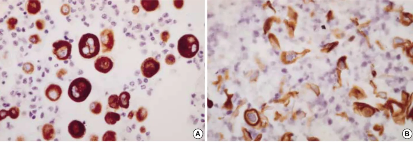 Fig. 5. Mesothelial cells (A, ×400) and metastatic squamous cell carcinoma of the lung (B, ×400) exhibit diffuse strong membranous/cyto- membranous/cyto-plasmic staining for CK5/6.