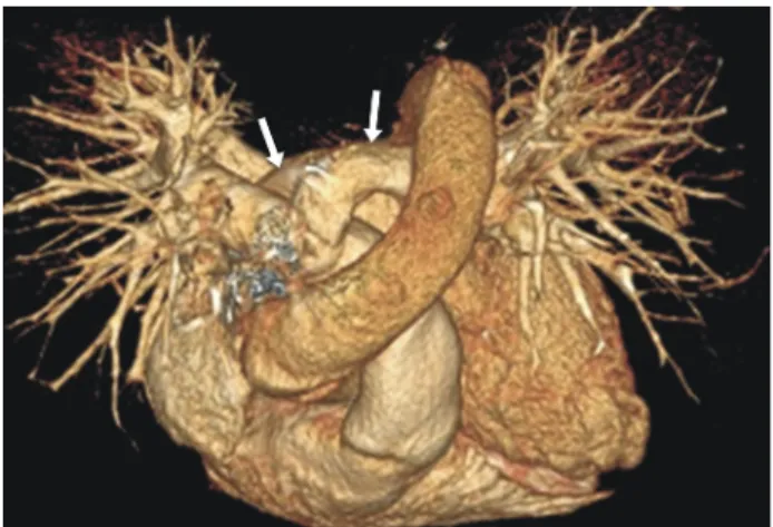 Fig. 2. Three-dimensional computed chest tomography showing the rise of an abnormal left pulmonary artery (arrow) from the posterior aspect of the right pulmonary artery and its passage  along the right lateral wall of the trachea.
