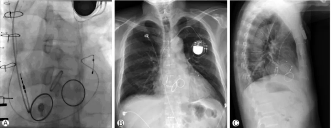 Fig. 4. Fluoroscopy after the permanent pacemaker implantation that shows the location of the ventricular pacemaker lead in the posterior cardiac vein via the coronary sinus (A) and a chest X-ray (B, C)