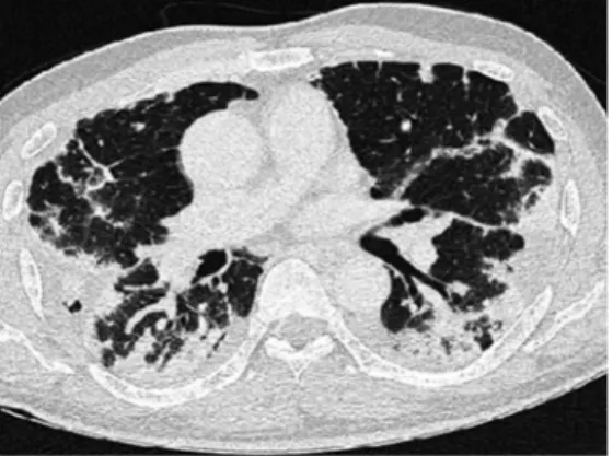 Fig. 6. Chest X-ray findings. The infiltration was much decreased in both lung fields on day 17 after conservative management.