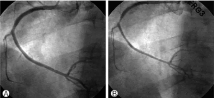 Fig. 3. Coronary angiography on postoperative 1 month. (A)  Normal finding of the right coronary artery