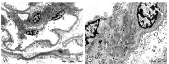 Fig. 2. Ultrastructural findings. The foot processes of the epithelial cells are effaced (arrow)