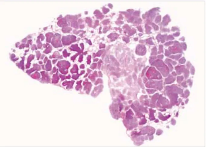 Fig. 2. Histologic section shows numerous micronodules in the alveolar spaces (H&amp;E,  × 1).