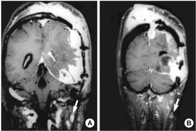 Fig. 2. Radiologic findings. (A, B) Gd-enhanced coronal T1-weight- T1-weight-ed MR images of the brain show multiple lymph adenopathies in deep cervical area (arrows)