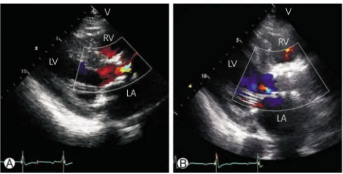 Fig. 3. The patient’s pressure curve on aortic valve. (A) Before  TAVI procedure, pressure gradient of aortic valve showed ele-  vated (peak/mean pressure gradient=117/74 mmHg)