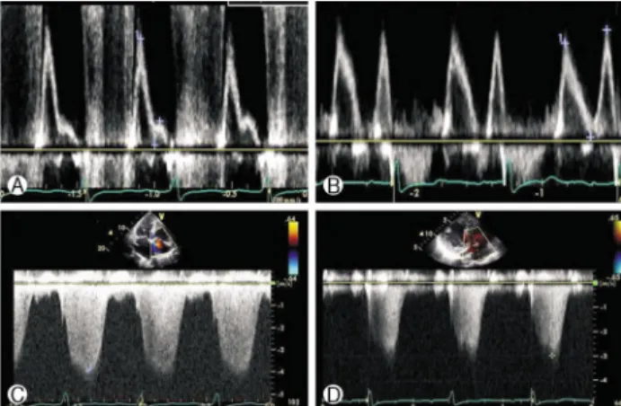 Fig. 5. The patient’s Doppler flow study. (A, C) Before TAVI  procedure, echocardiography showed diastolic dysfunction and  increased RVSP (DT=96 msec, pseudonormalization pattern of  LV with elevated filling pressure, E/E’=37, RVSP=86 mmHg)