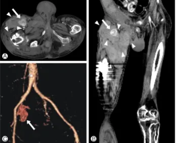 Fig. 1. Computed tomographic angiography shows about 3.5×3 cm sized bilobulated pseudoaneurysm (arrow) at the puncture site of right femoral artery, with active contrast filling, combined with large amount of surrounding deep soft tissue hematomas  (arrowh