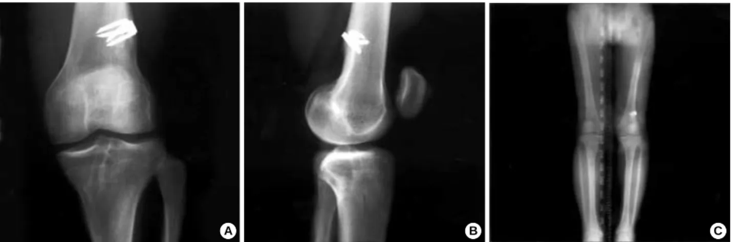 Fig. 3. Anteroposterior (A) and lateral (B) radiograms, and an orthoroentgenogram (C) of a 21-yr-old male at 7 yr 5 months postoperative- postoperative-ly showing a closed physes and no angular deformity or leg length discrepancy compared with the uninjure