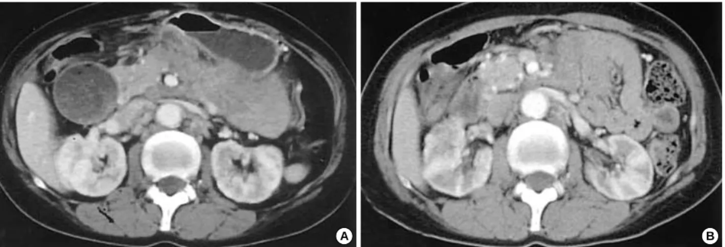 Fig. 1. Abdominal computed tomography (CT) scan shows the multiple conglomerated soft tissue density lesions noted at the mesenteric root, aortocaval space and left paraaortic space; the CT scan also shows the smooth luminal narrowing noted at the third po