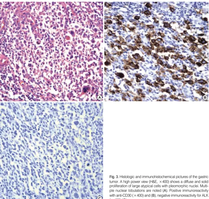 Fig. 3. Histologic and immunohistochemical pictures of the gastric tumor. A high power view (H&amp;E, ×400) shows a diffuse and solid proliferation of large atypical cells with pleomorphic nuclei