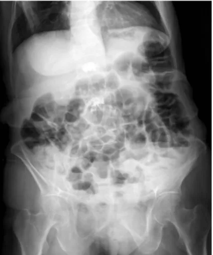 Fig. 1. An erect abdominal radiograph revealed dilatation of  gas-filled bowel loops.