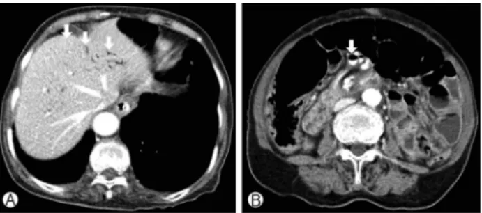 Fig. 5. A follow-up abdominal computed tomography scan (8 days after Fig. 4) revealed the disappearance of the hepatic portal  venous gas