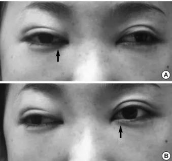Fig. 1. (A) Left lateral gaze and (B) Right lateral gaze. This patient shows marked bilateral limitation of adduction not crossing  mid-line (arrows), but no limitation of abduction, elevation and  depres-sion in eyeball movement.
